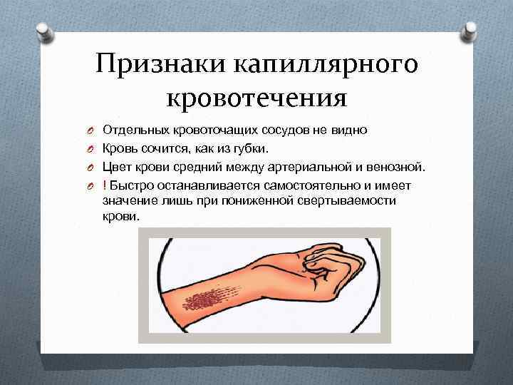 Признаки капиллярного кровотечения O Отдельных кровоточащих сосудов не видно O Кровь сочится, как из
