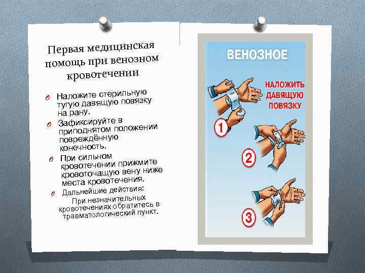 я Первая медицинска м помощь при венозно кровотечении рильную O Наложите сте овязку тугую