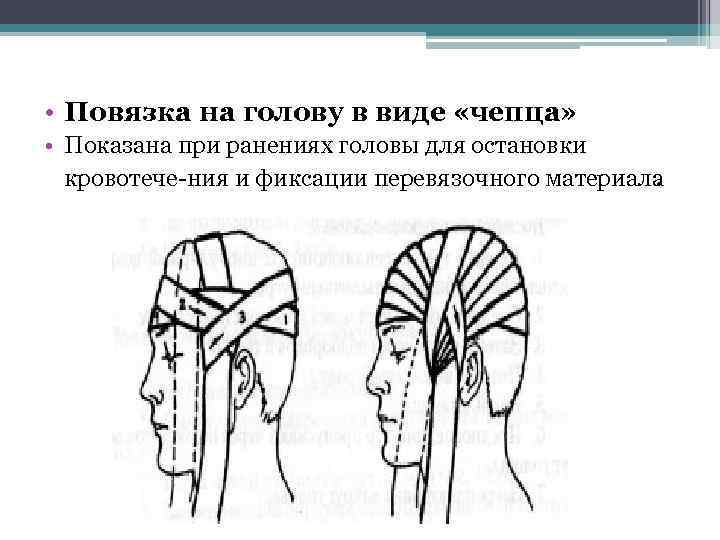  • Повязка на голову в виде «чепца» • Показана при ранениях головы для