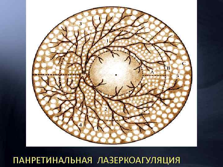 ПАНРЕТИНАЛЬНАЯ ЛАЗЕРКОАГУЛЯЦИЯ 