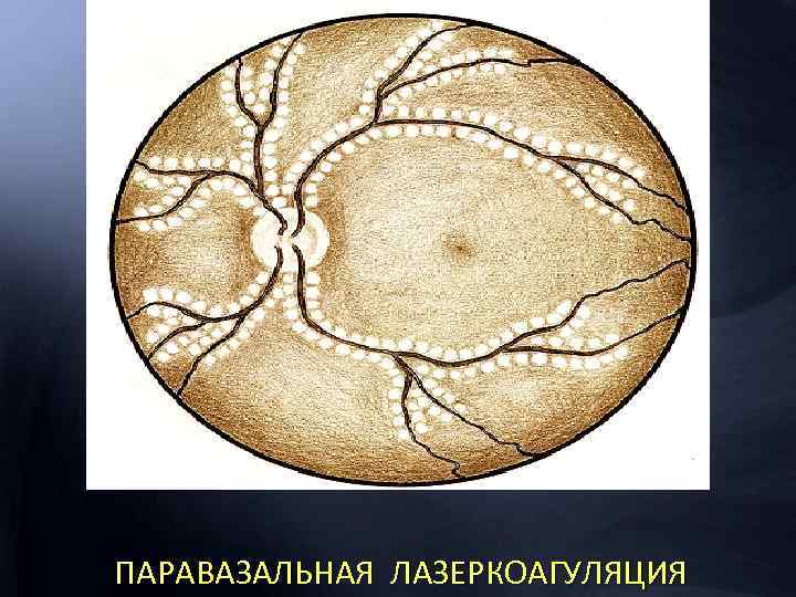 ПАРАВАЗАЛЬНАЯ ЛАЗЕРКОАГУЛЯЦИЯ 