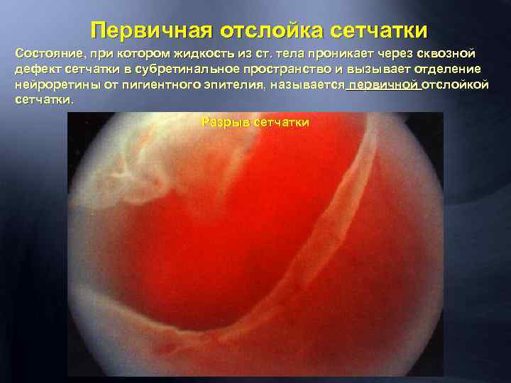 Первичная отслойка сетчатки Состояние, при котором жидкость из ст. тела проникает через сквозной дефект