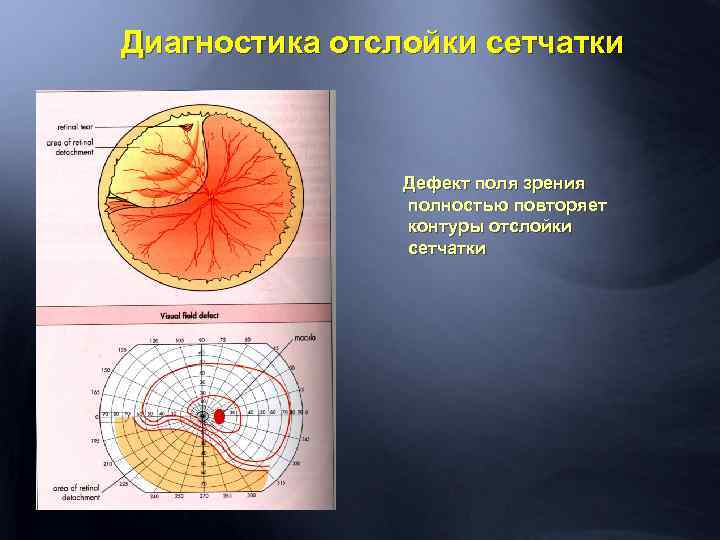 Диагностика отслойки сетчатки Дефект поля зрения полностью повторяет контуры отслойки сетчатки 
