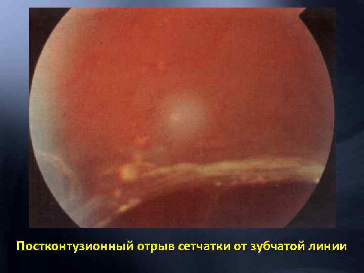 Постконтузионный отрыв сетчатки от зубчатой линии 