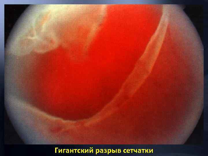 Гигантский разрыв сетчатки 