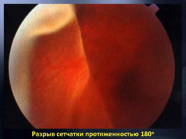 Разрыв сетчатки протяженностью 180 о 