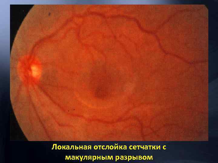 Локальная отслойка сетчатки с макулярным разрывом 