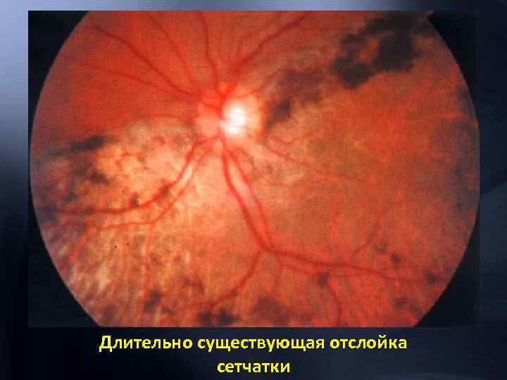 Длительно существующая отслойка сетчатки 