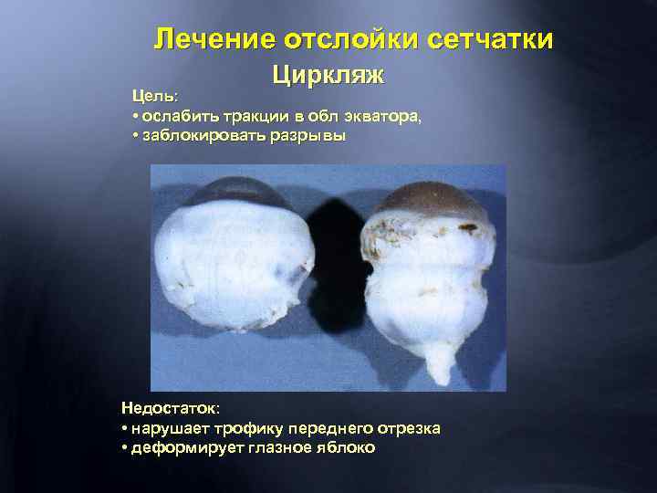 Лечение отслойки сетчатки Циркляж Цель: • ослабить тракции в обл экватора, • заблокировать разрывы