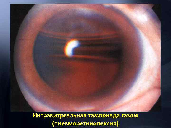 Интравитреальная тампонада газом (пневморетинопексия) 