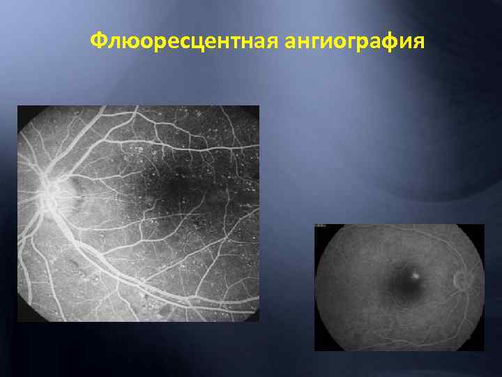 Флюоресцентная ангиография 