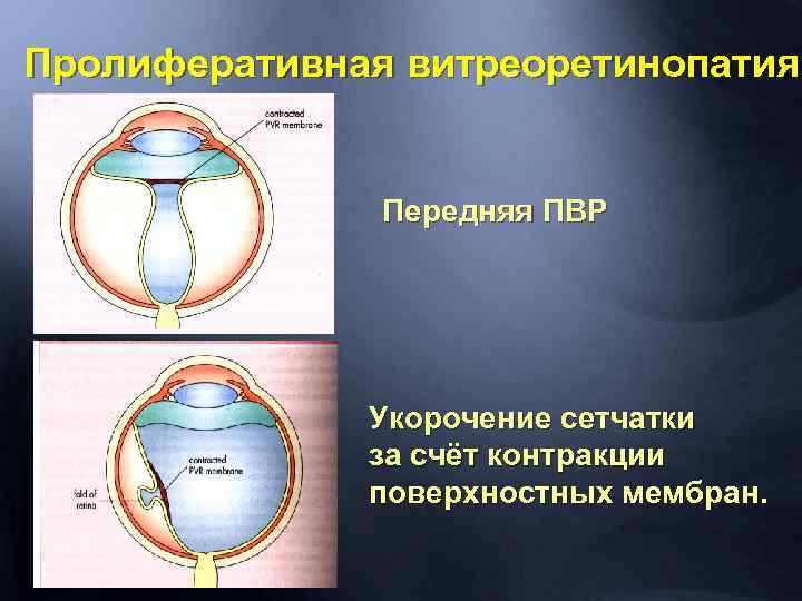 Пролиферативная витреоретинопатия Передняя ПВР Укорочение сетчатки за счёт контракции поверхностных мембран. 