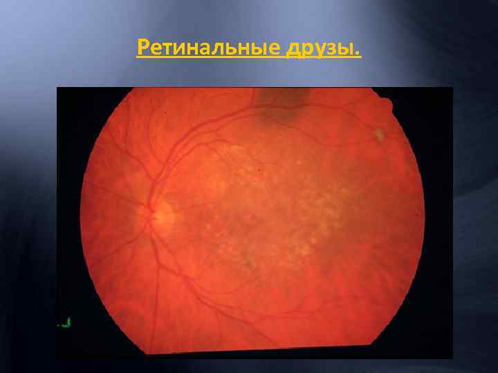 Ретинальные друзы. 