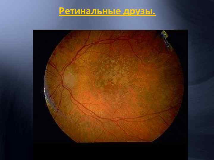 Ретинальные друзы. 