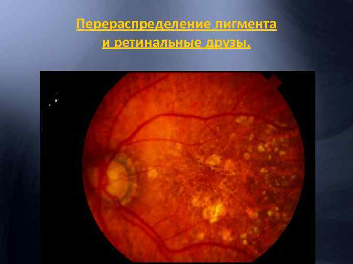 Перераспределение пигмента и ретинальные друзы. 