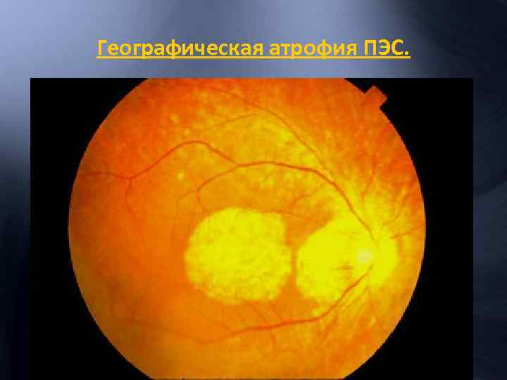 Географическая атрофия ПЭС. 