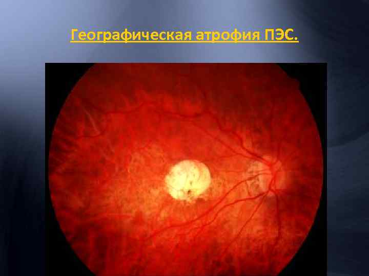 Географическая атрофия ПЭС. 
