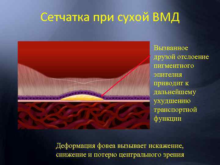 Сетчатка при сухой ВМД Вызванное друзой отслоение пигментного эпителия приводит к дальнейшему ухудшению транспортной