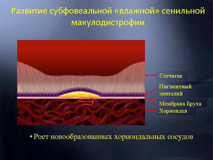 Развитие субфовеальной «влажной» сенильной макулодистрофии Сетчатка Пигментный эпителий Мембрана Бруха Хориоидея • Рост новообразованных