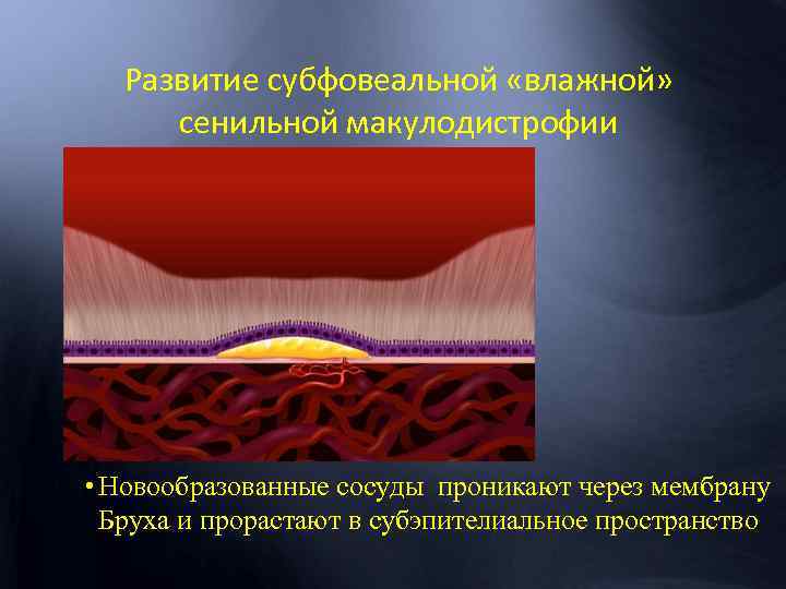 Развитие субфовеальной «влажной» сенильной макулодистрофии • Новообразованные сосуды проникают через мембрану Бруха и прорастают