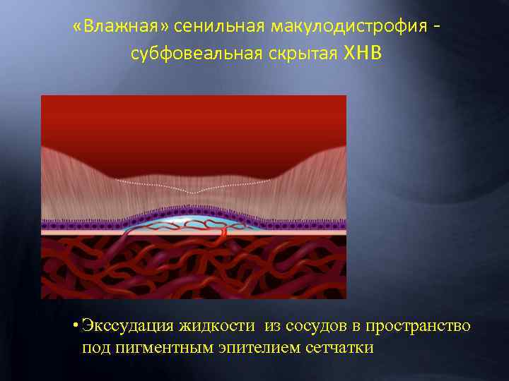  «Влажная» сенильная макулодистрофия субфовеальная скрытая ХНВ • Экссудация жидкости из сосудов в пространство