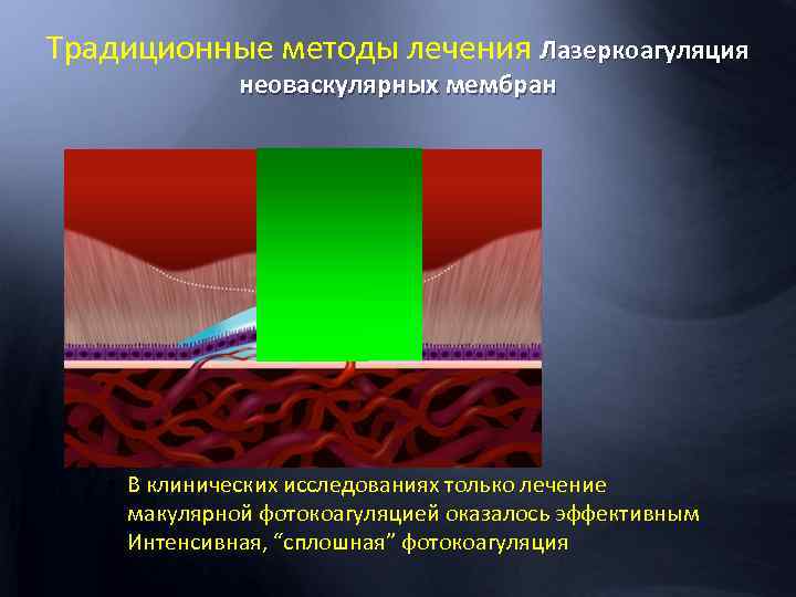 Традиционные методы лечения Лазеркоагуляция неоваскулярных мембран • В клинических исследованиях только лечение макулярной фотокоагуляцией