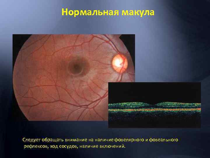 Нормальная макула Следует обращать внимание на наличие фовелярного и фовеального рефлексов, ход сосудов, наличие