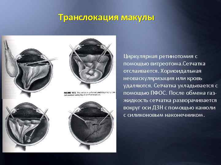 Транслокация макулы Циркулярная ретинотомия с помощью витреотома. Сетчатка отслаивается. Хориоидальная неоваскуляризация или кровь удаляются.