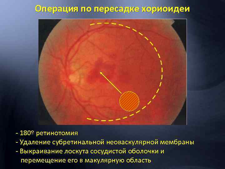 Операция по пересадке хориоидеи - 180º ретинотомия - Удаление субретинальной неоваскулярной мембраны - Выкраивание