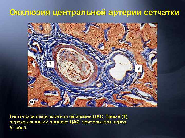 Окклюзия центральной артерии сетчатки Гистологическая картина окклюзии ЦАС. Тромб (Т), перекрываюший просвет ЦАС зрительного
