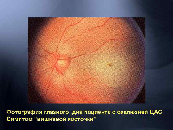 Фотография глазного дна пациента с окклюзией ЦАС Симптом “вишневой косточки” 