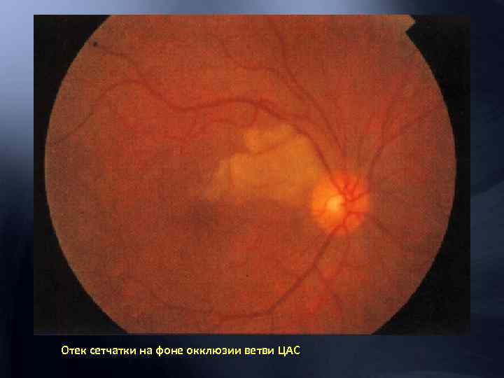 Отек сетчатки на фоне окклюзии ветви ЦАС 