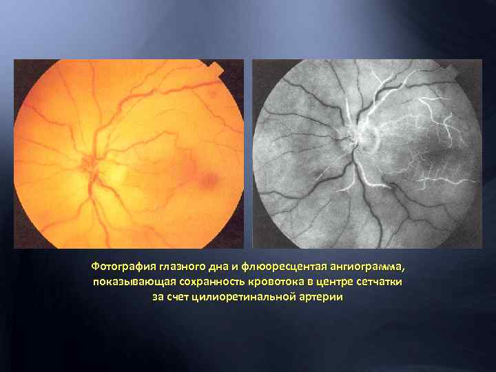 Фотография глазного дна и флюоресцентая ангиограмма, показывающая сохранность кровотока в центре сетчатки за счет