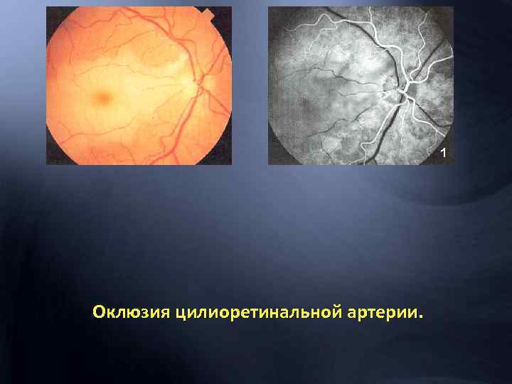 1 Оклюзия цилиоретинальной артерии. 