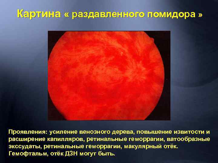 Картина « раздавленного помидора » Проявления: усиление венозного дерева, повышение извитости и расширение капилляров,