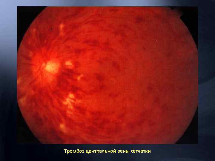 Тромбоз центральной вены сетчатки 