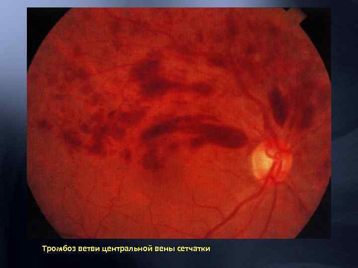 Тромбоз ветви центральной вены сетчатки 