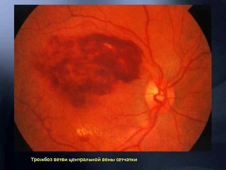 Тромбоз ветви центральной вены сетчатки 