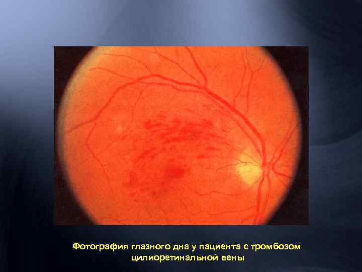 Фотография глазного дна у пациента с тромбозом цилиоретинальной вены 