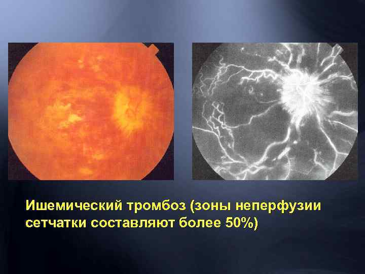 Ишемический тромбоз (зоны неперфузии сетчатки составляют более 50%) 