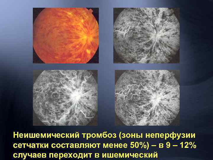 Неишемический тромбоз (зоны неперфузии сетчатки составляют менее 50%) – в 9 – 12% случаев