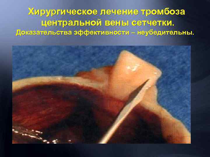 Хирургическое лечение тромбоза центральной вены сетчетки. Доказательства эффективности – неубедительны. 