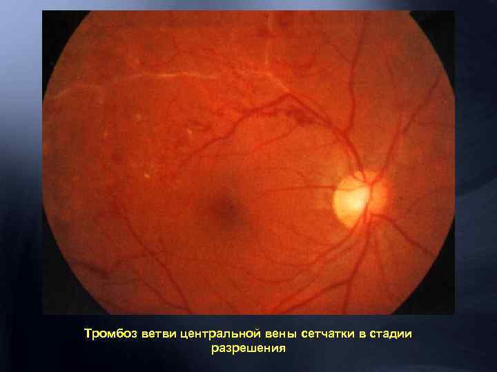 Тромбоз ветви центральной вены сетчатки в стадии разрешения 