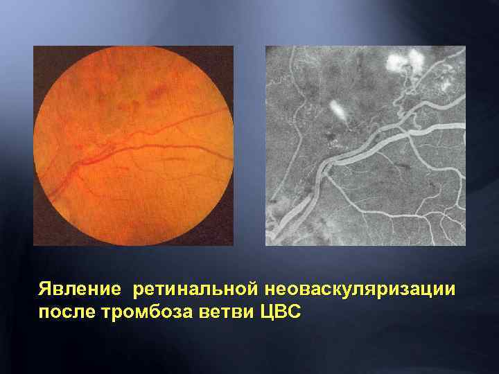 Явление ретинальной неоваскуляризации после тромбоза ветви ЦВС 