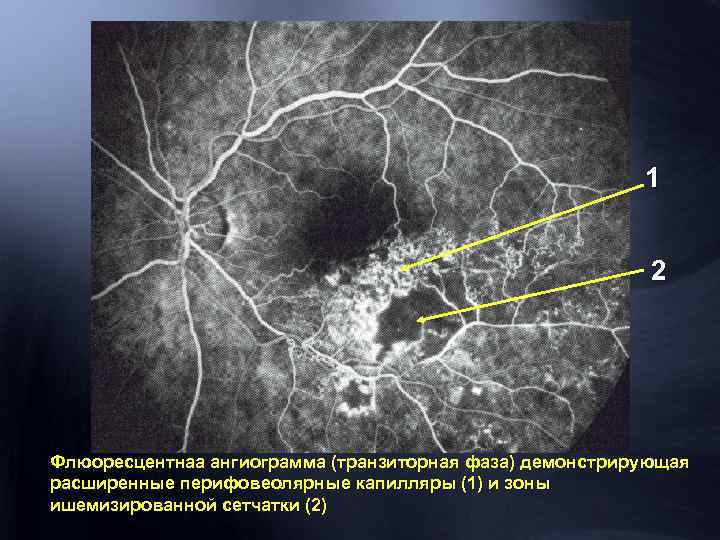 1 2 Флюоресцентнаа ангиограмма (транзиторная фаза) демонстрирующая расширенные перифовеолярные капилляры (1) и зоны ишемизированной