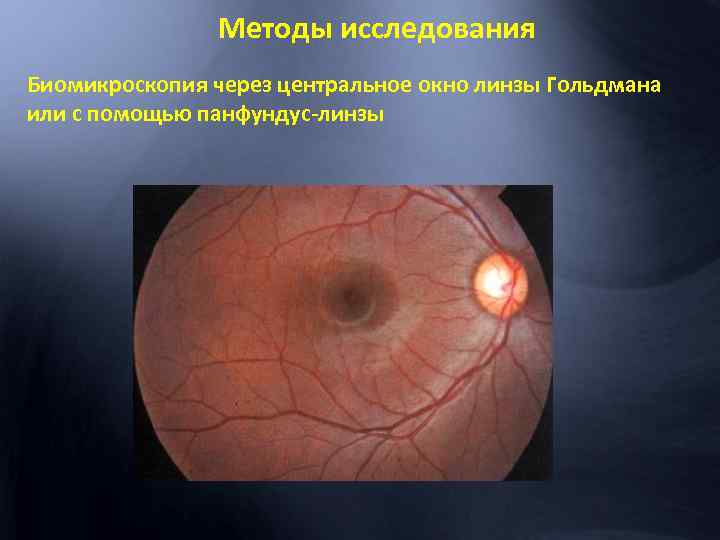 Методы исследования Биомикроскопия через центральное окно линзы Гольдмана или с помощью панфундус-линзы 