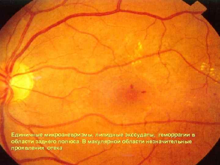Единичные микроаневризмы, липидные экссудаты, геморрагии в области заднего полюса. В макулярной области незначительные проявления
