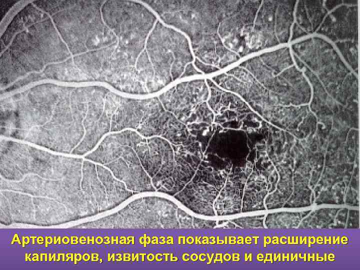 Артериовенозная фаза показывает расширение капиляров, извитость сосудов и единичные 