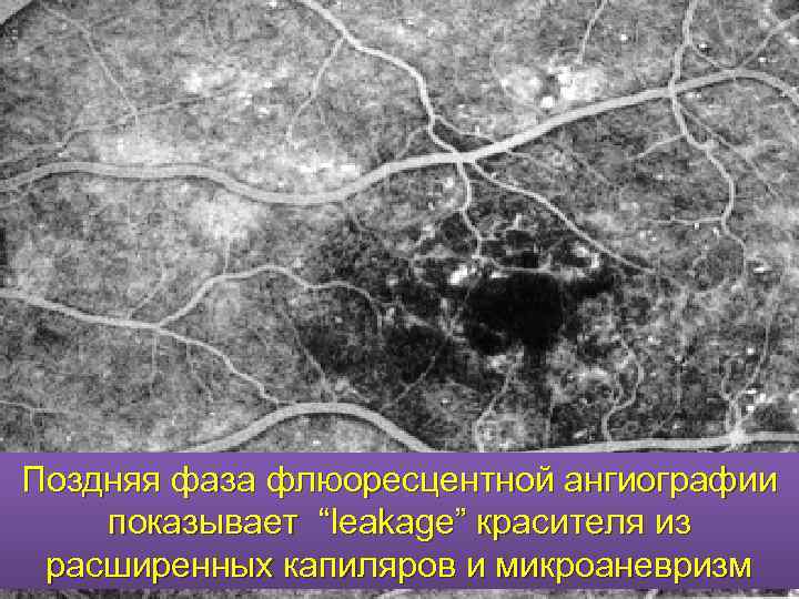 Поздняя фаза флюоресцентной ангиографии показывает “leakage” красителя из расширенных капиляров и микроаневризм 