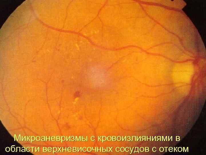 Микроаневризмы с кровоизлияниями в области верхневисочных сосудов с отеком 